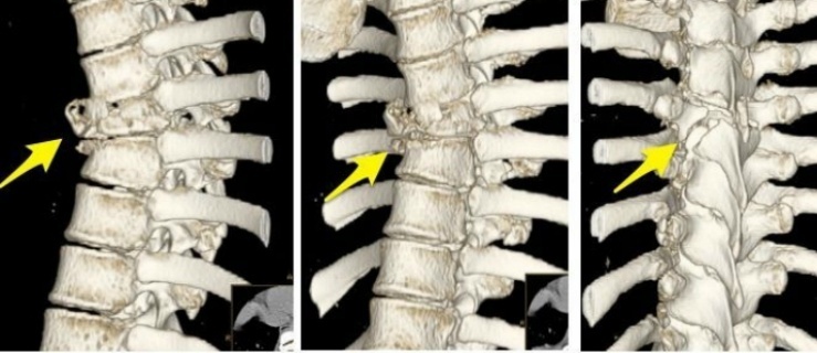  Złamania kręgów T7 i T8 w przedoperacyjnych obrazach 3D tomografii komputerowej. Strzałki wskazują złamany kręg T7 