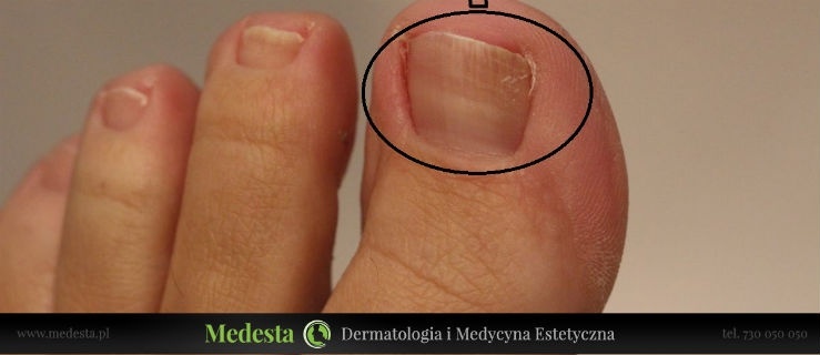 Terapia grzybicy paznokci laserem Lunula