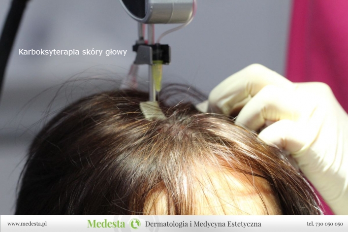 Karboksyterapia skóry głowy