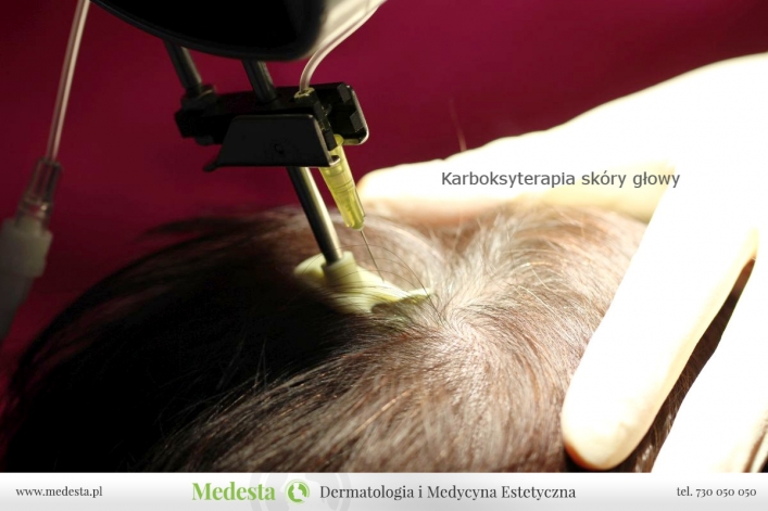 Mezoterapia skóry głowy