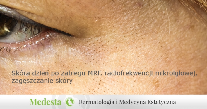 Skóra po zabiegu MRF, zagęszczanie skóry