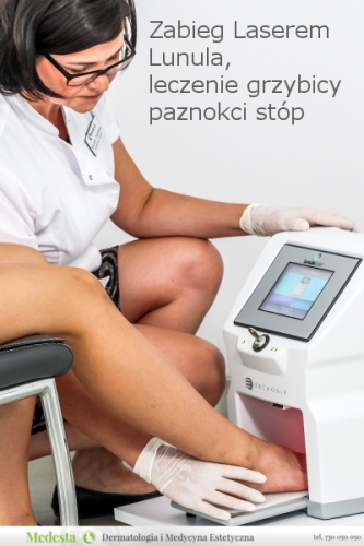 Zabieg laserem Lunula, leczenie grzybicy paznokci stóp
