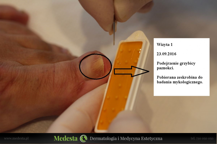 Terapia grzybicy paznokci laserem Lunula