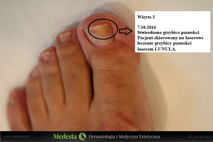 Terapia grzybicy paznokci laserem Lunula