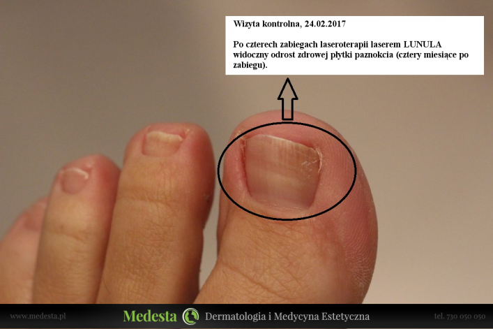 Terapia grzybicy paznokci laserem Lunula